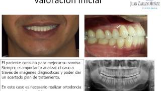 Ortodoncia Blanqueamiento Diseño de Sonrisa