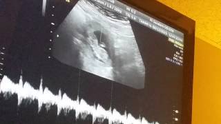 10 week 5 day ultrasound