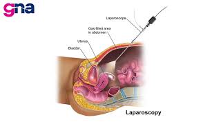 PCOS Journey: 4 Years of Letrozole & IUI | Hope for Pregnancy?