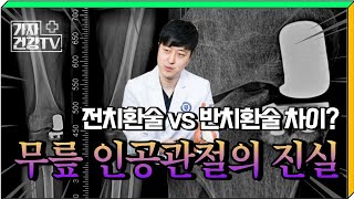 무릎 통증 치료의 끝판왕 인공관절수술! 전치환술 vs 반치환술?