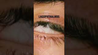 LAGOPHTHALMOS