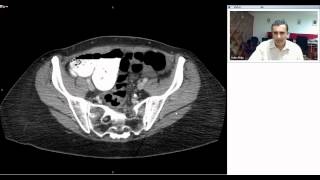 Radiology - Splenic rupture following colonoscopy by Dr Arjun Kalyanpur