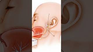 facial nerve Hypoglossal nerve anastomosis