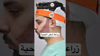 ‏مراحل زراعة شعر اللحية #زراعةالشعر #زراعة￼