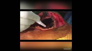 Giant Cell Tumor (GCT) Surgery with Extended Currretage and Bone Cement