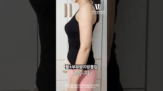 팔+부유방 지방흡입 후기 #shorts