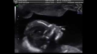 Oliver's 19 Week Ultrasound