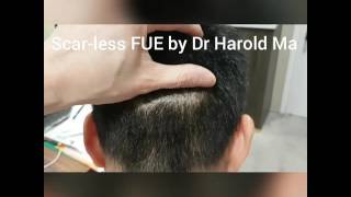 Scar-less FUE by Dr Harold Ma Singapore