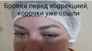 Результат после схода корочек