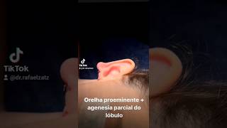 Otoplastia para orelha de abano e agenesia.