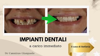 Caso di impianto dentale su un singolo dente - Cannizzo Studio Milano