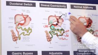 Weight Loss Surgical Procedures Part 3 - Ghrelin (overly simplified)