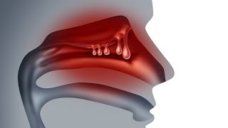 Novel Therapies for Chronic Rhinosinusitis with Nasal Polyps (CRSwNP)