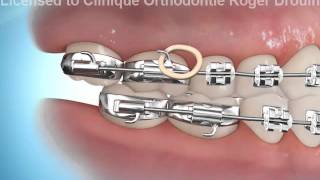 orthodontie et élastiques pour corriger une malocclusion cl.III