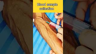 #ivinjection #ivcannulation #bloodsample #mltclasses #dmlt_video #dmlt #dmlt_video