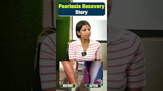 My psoriasis story  | बचपन के सोरायसिस का जड़ से इलाज | Psoriasis recovery in Hindi #shorts