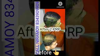 PRP Hair treatment Before and After | PRP Treatment | PRP #shorts