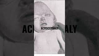 acrocephaly