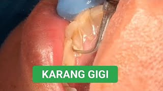 SCALING DI DOKTER GIGI | MEMBERSIHKAN KARANG GIGI