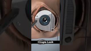 Cirugía LASIK? #shortvideo