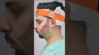 Beard Transplant Result After 10 Days - Islam Beard Transplant Experience