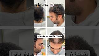 نتيجة زراعة الشعر في عيادة  بادرا #hairtransplant #fashiontrends #hairloss #hairclinic  #زراعةالشعر