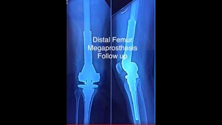 Osteosarcoma or Bone Tumor of Knee Joint treated with Joint replacement Surgery