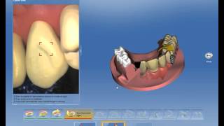 CEREC ORTHO 1.1