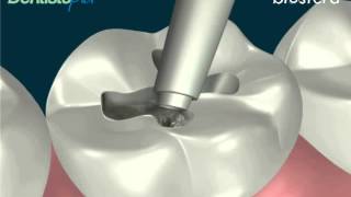 Le otturazioni dentali in amalgama