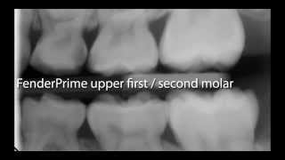 DIRECTA ● FenderPrime - Upper First and Second Molar II