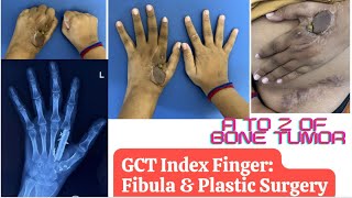 Giant Cell Tumor (GCT) of Hand