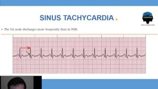 3  Taquicardia Sinusal