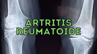 TODO SOBRE Artritis Reumatoide