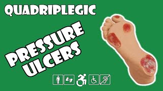 Pressure Sores Explained | Quadriplegic (C5,C6,C7)