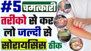 Skin psoriasis treatment | 5 चमत्कारी तरीको से कर लो जल्दी से सोरायसिस ठीक | Bharat Homeopathy