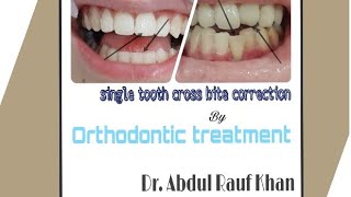 Crossbite Correction