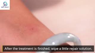 Freckle Remover