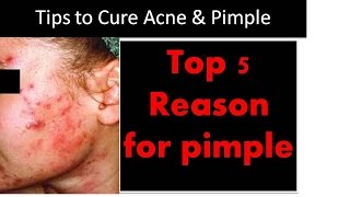 Top 5 Reason for Pimple and acne - with bloopers !!!!!