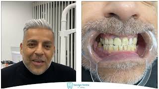 Implant treatment in Turkey