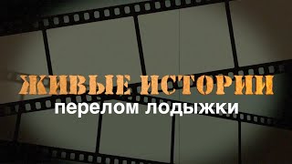 Перелом лодыжки