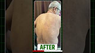 😱 Psoriasis Treatment Results After 3 Months | सोरायसिस हुआ जड़ से ठीक✅ #shorts #shortfeed #psoriasis