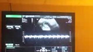 Ultrasound 10 weeks 5d