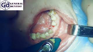 Infiltration anesthesia for implantation 31.