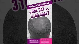 Amazing Hair Transplant in One Day with 3100 Grafts #hairtransplant #hairlosscure #hairgrafting