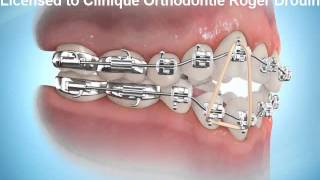 Port d'élastiques en orthodontie