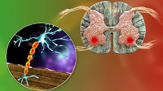 Emerging strategies in the Diagnosis and Treatment of Amyotrophic Lateral Sclerosis (ALS)