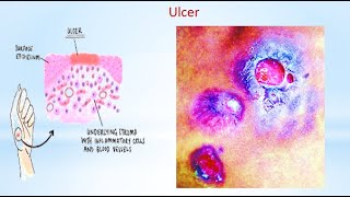 Ulcer