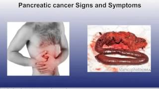 Signs, symptoms and risk factors of pancreatic cancer