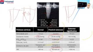 O que mede-se na prótese aórtica?