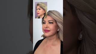 Facelift Make Her Look 15 Years Younger! Full Facial Plastic Surgery Transformation 🤯